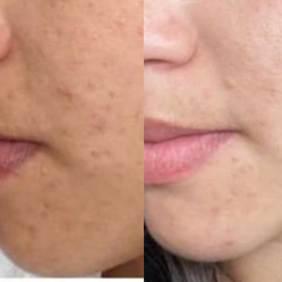 Before and After