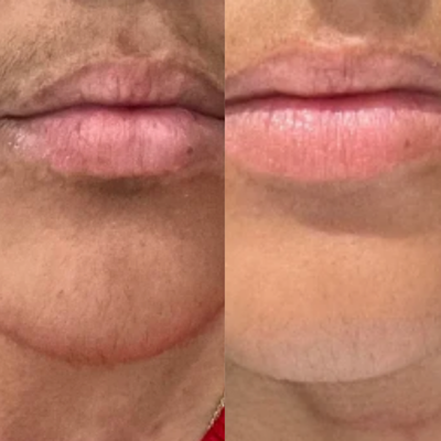 Before and After