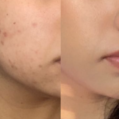 Before and After