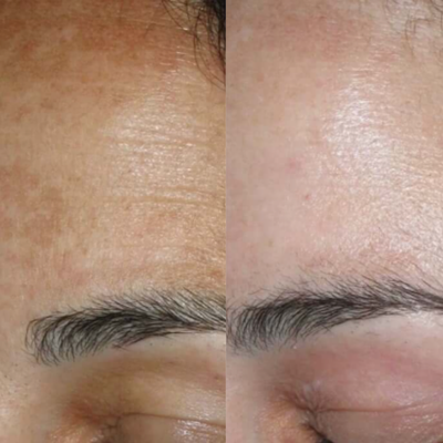 Before and After