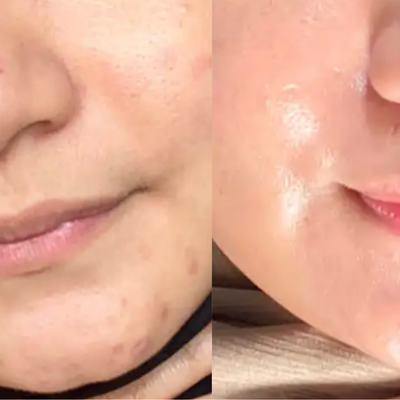 Before and After